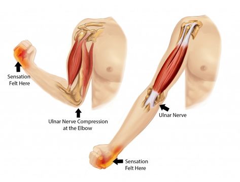 Cubital Tunnel Syndrome: Cubital tunnel syndrome is a condition that affects the ulnar nerve where it passes the inside edge of the elbow. Cubital tunnel syndrome is the second common compression neuropathy in the upper extremity. Numbness and tingling sensation in the hand and fingers are common symptoms of cubital tunnel syndrome.  Advanced disease is … Carpal Tunnel Exercises, Cubital Tunnel Syndrome, Nerve Relief, Carpal Tunnel Relief, Nerve Problems, Ulnar Nerve, Forearm Muscles, Fitness Jobs, Muscle Atrophy