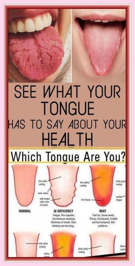 What does your tongue say about your health?#tonguehealth #oralwellness #healthytongue #tongueanalysis #oralhygiene #tonguehealthcare #tonguehealthtips #tonguehealthmatters #tonguehealthawareness #tonguehealthjourney Nails And Health, Tips For Healthy Skin, What Is Health, Health Women, Tongue Health, Health Signs, Food Is Good, Health Tips For Women, Feeling Hot