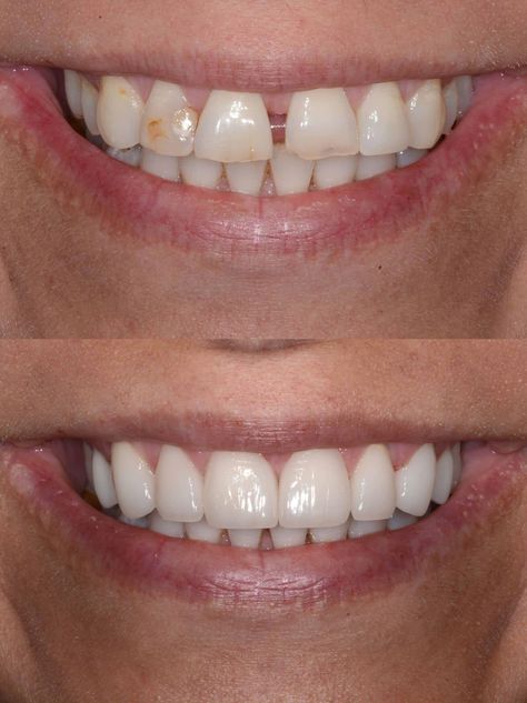 Don't like the space between your front teeth?   Dr. Hulse can fix that with several different methods. Smile Tips, Dental Animation, Space Between Teeth, Dental Business Cards, Hollywood Smile, Dental Posters, Windows To The Soul, Unwanted Hair Growth, Dental Fun