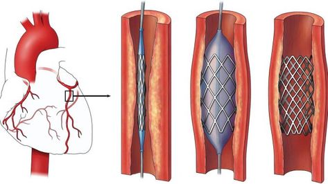 Cardiovascular Implants Market Report, Global Industry Overview, Growth, Opportunities and Forecast 2019-2024 Heart Stent, Deep Brain Stimulation, Heart Hospital, Heart Valves, Open Heart Surgery, Heart Muscle, Coronary Arteries, Heart Surgery, Heart Conditions