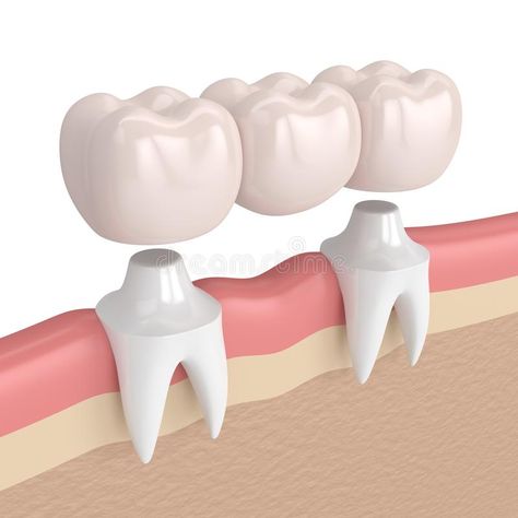 Denture Repair Kits, Tooth Bridge, Dental Bridge Cost, Denture Repairs, Tooth Crown, Dental Insurance Plans, Dental Exam, Missing Teeth, Dental Bridge