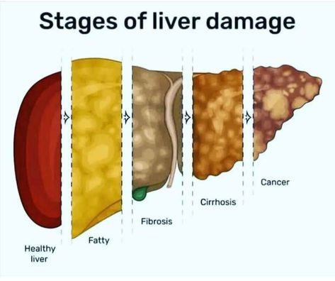 Liver Anatomy, Medical Things, Basic Anatomy, Bells Palsy, Basic Anatomy And Physiology, Biology Facts, Cupping Therapy, Medicine Doctor, Healthy Liver