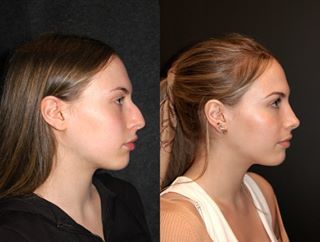 Deep Plane Facelift New York | Best Deep Plane Facelift Refined Nose Tip, Defined Nose Bridge, Nose Rhinoplasty Before After, Nose Plastic Surgery Before After, Nose Before And After, Nose Jobs Before And After, Nose Job Before And After Rhinoplasty, Bulbous Nose Rhinoplasty Before After, Rhinoplasty Before After