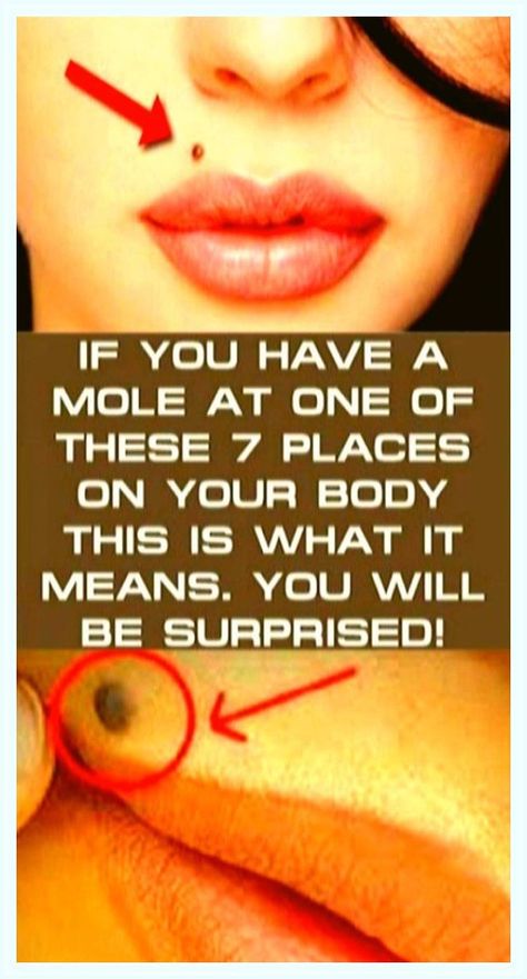 IF YOU HAVE A MOLE AT ONE OF THESE 7 PLACES ON YOUR BODY THIS IS WHAT IT MEANS-YOU WILL BE SURPRISED Moles On Face, School Communication, Interpersonal Skills, Health Magazine, Natural Treatments, Natural Medicine, Diet Tips, Natural Healing, Healthy Tips