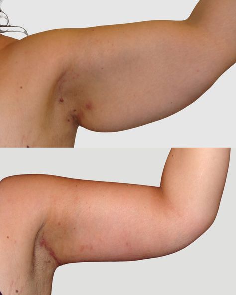 We LOVE this result and we think you will too 💪🏻 Operating surgeon: Dr. Spiros Vlahos 🥼 Arm lift or brachioplasty is a body contouring procedure designed to reshape and slim the underside of the arms by removing fat and loose skin sometimes caused by significant weight loss. Start your confidence journey at CFS today: ▫️Click the contact button on our page 📞 0207 993 4849 📧 contact@centreforsurgery.com 📍 95-97 Baker Street, Marylebone, London, W1U 6RN State-of-the-art cosmetic surgery ... Arm Lift, Fat Removal, Loose Skin, Body Contouring, Cosmetic Surgery, Baker Street, Skin