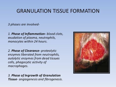 granulation tissue | Wound healing Nursing Infographic, Wound Care Nursing, Granulation Tissue, Wound Care, Wound Healing, Nurse Humor, Postpartum, Assessment, Nursing