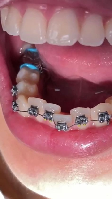 Amazing braces transformation! [Video] | Getting braces, Braces transformation, Braces tips Braces Transformation, Dental Wallpaper, Braces Tips, Getting Braces, Braces Off, Orthodontic Appliances, Men Skin Care Routine, Dental Videos, Braces Colors