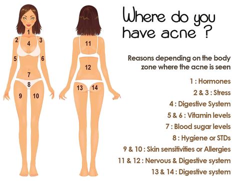 where do you have acne? Body Chart, Natural Acne Remedies, Natural Acne, Body Acne, Acne Breakout, Cystic Acne, Acne Remedies, Natural Therapy, Skin Remedies