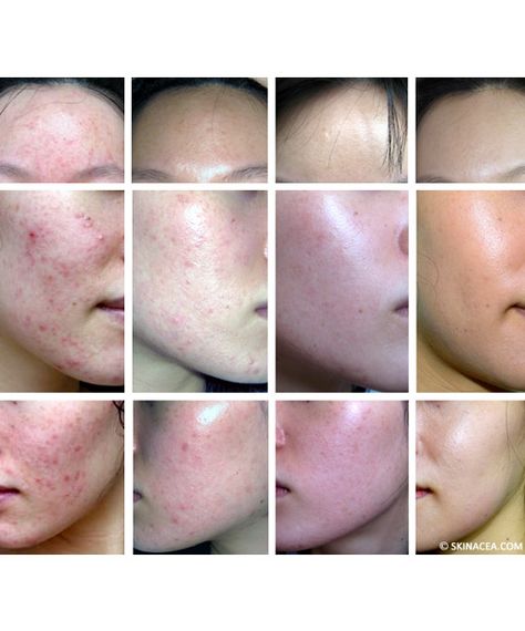 I Spent Thousands Battling Hormonal Acne, and a $20 Regimen Cured It | Through a four-year trial-and-error method, I finally found what keeps my acne under control. Post Acne Marks, Natural Acne, Severe Acne, Hormonal Acne, Beauty Remedies, Acne Remedies, Skin Remedies, Acne Marks, How To Get Rid Of Acne