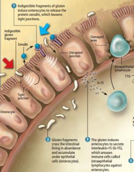 This is how Gluten causes leaky guts in people with Celiac Disease - find out why here http://scdlifestyle.com/2012/02/how-gluten-causes-celiac-disease/ Celiac Awareness, Gluten Free Info, Coeliac Disease, Gluten Free Living, Gluten Sensitivity, Gluten Free Foods, Gluten Intolerance, Gluten Free Eating, Gluten Free Food