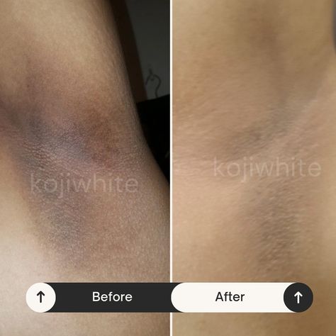 Say goodbye to dark underarms! 🙌✨ Here’s our stunning before and after using the Koji White Underarm Serum. 🌸 Notice the difference? Brighter, smoother, and more confident skin in no time! 💖 Ready to make the switch? #KojiWhite #UnderarmCare #BeforeAndAfter #BrighteningSerum Dark Armpits, Dark Underarms, The Switch, Brightening Serum, After Dark, Say Goodbye, No Time, Serum, Skin