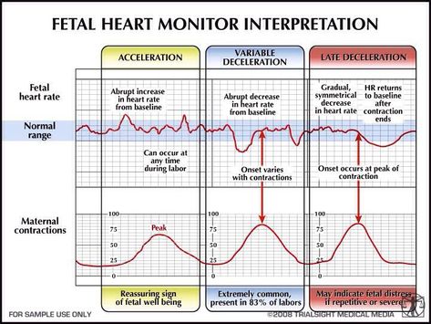 OB Fetal Heart Tone Monitoring Decelerations-Learn how to view, detect, and monitor fetal heart tones by the monitoring decelerations sheet. Description from pinterest.com. I searched for this on bing.com/images Ob Emergencies, Fetal Heart Monitoring, Fetal Monitoring, Nurse Things, Newborn Nursing, Contraception Methods, Child Nursing, Student Midwife, Ob Nursing