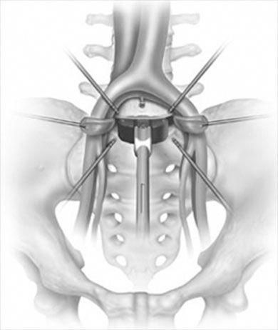 L5-S1 Degenerative Disc Disease. What Surgical Options Do I Have for Accessing the Anterior L5-S1 Interspace? L5 S1, Sciatic Nerve Pain Relief, Foot Reflexology Massage, Intervertebral Disc, Degenerative Disease, Spine Health, Spine Surgery, Nerve Pain Relief, Foot Reflexology