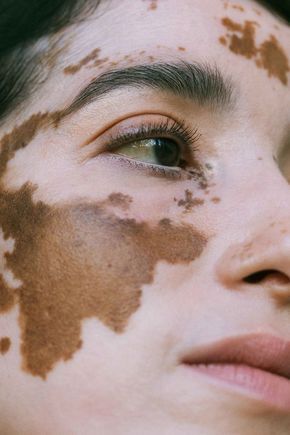 35 Beautiful Women With Vitiligo Shot By A Photographer Who Has The Same Condition Real Bodies, Skin Therapy, Beauty Standards, Shooting Photo, Medical Prescription, Real Beauty, Skin Conditions, Beauty Photography, Body Positivity