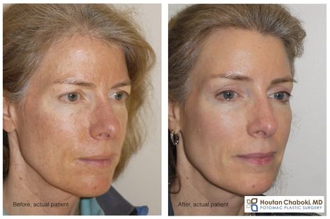 Brow lift surgery – Traditional vs. Endobrow forehead lift | Potomac Plastic Surgery Endoscopic Brow Lift, Brow Lift Surgery, Botox Brow Lift, Forehead Lift, Facial Anatomy, Upper Eyelid, Facial Plastic, Brow Lift, Plastic Surgeon