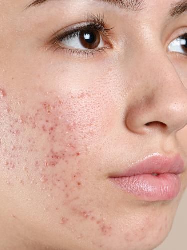 different types of acne
scar treatment
best acne treatment
types of acne
acne positivity
scar removal
acne map
hyperpigmentation
hyperpigmentation black skin
dark spots remedies
dark spots
clear glowing skin
clear skin Acne Images, Acne Positivity, Facial Peels, Acne Scar Diy, Blind Pimple, Pimples Under The Skin, Acne Overnight, Pimples Overnight, Cosmetic Creative