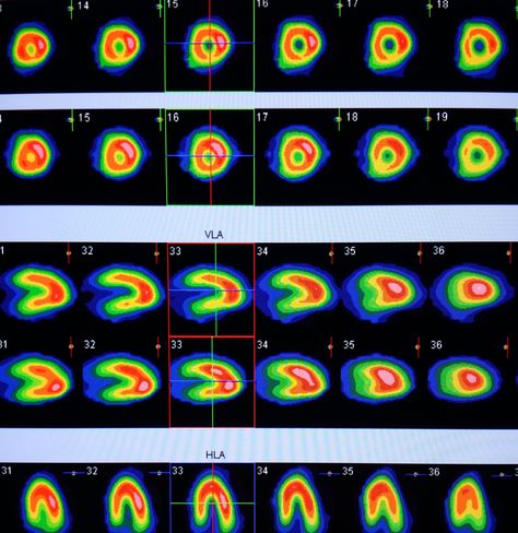 #Nuclear #medicine study of the #heart to look for #coronary #artery #disease in a #patient with #chest #pain. Heart #attack #radiology #radiologist Nuclear Medicine Technologist Aesthetic, Nuclear Medicine Technologist, Coronary Artery, Nuclear Medicine, Diagnostic Imaging, Medical Imaging, Chest Pain, Radiology, Case Study