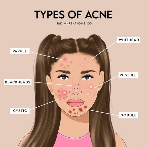 Female Acnes Acne Safe Makeup, Face Mapping Acne, Safe Makeup, Acne Help, Acne Prone Skin Care, Face Mapping, Acne Free, Hormonal Acne, Face Acne