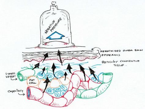 Hijama Points, Cupping Points, Chinese Cupping, Acupuncture Points Chart, Hijama Cupping, Osmotic Pressure, Bed Sores, Cupping Massage, Massage Therapy Techniques