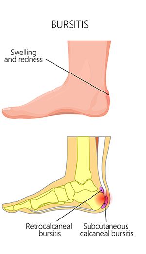 Bursitis | Foot Health | Patients | APMA Achilles Bursitis, Heel Bursitis, Haglunds Deformity, Achilles Pain, Achilles Tendon, Body Coach, Foot Injury, Simple Health, Heath And Fitness