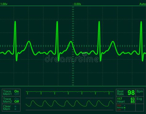 Heart monitor screen. With normal beat signal #Sponsored , #AD, #Ad, #monitor, #signal, #beat, #Heart Human Heart Facts, Ecg Reading, Normal Ecg, Heart Facts, King And Queen Pictures, Medical Clip Art, Heart Monitor, Monitor Lizard, Dual Monitor