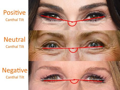 Negative Canthal Tilt Eyes, Positive Canthal Tilt, Negative Canthal Tilt, Canthal Tilt, Skin Spot Remover, Botox Lips, Plastic Surgery Gone Wrong, Face Anatomy, Facial Plastic Surgery