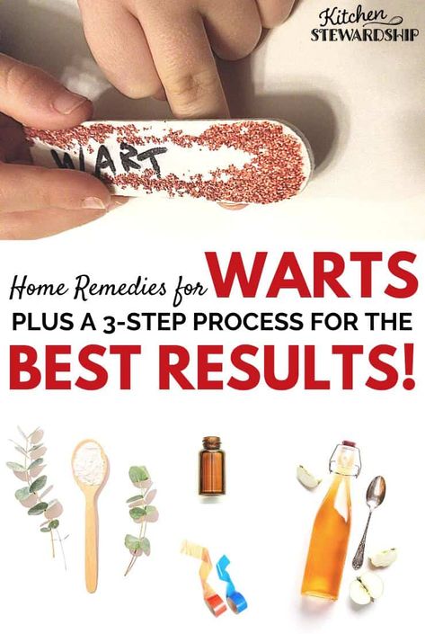 Home remedies for warts that are simple, natural, and cost-effective. Plus the three-step process that gets the best results! Remove warts naturally with these simple techniques put to the test by a real family. Home Remedy For Warts, Filiform Wart, Natural Wart Remedies, Flat Warts, Warts On Face, Home Remedies For Warts, Warts Remedy, Natural Remedies For Migraines, Allergy Remedies