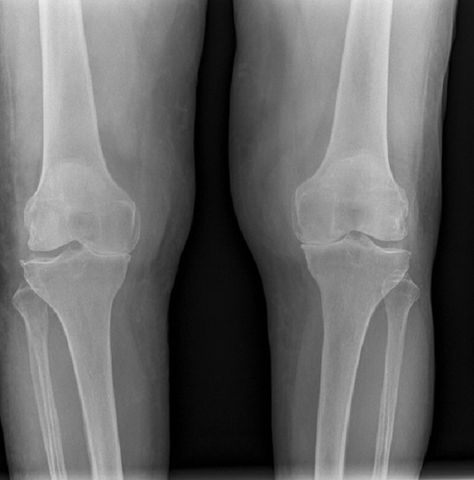 Bilateral knee X-ray showing osteoarthritis. Yes, ouch. Knee Xray, Yoga Information, Knee Replacement Surgery, Nerve Pain Relief, Sciatic Nerve Pain, Knee Exercises, Knee Surgery, Knee Replacement, Sciatic Nerve