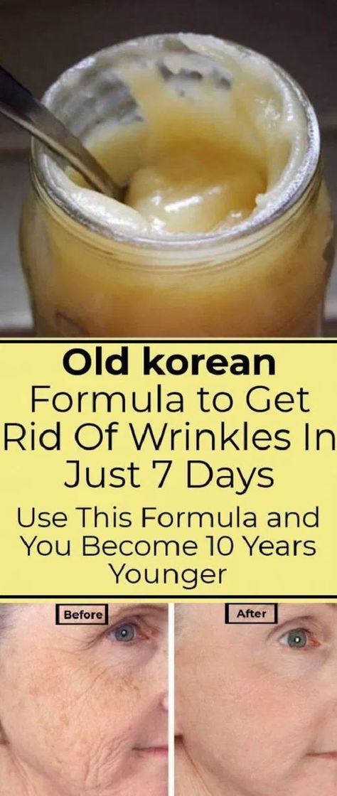 Old Korean Formula to Get Rid Of Wrinkles In Just 7 Days Use This Formula and You Become 10 Years Younger Get Rid Of Wrinkles, Erase Wrinkles, Natural Healing Remedies, Diy Remedies, Natural Therapy, Natural Cream, Wrinkle Cream, Natural Home Remedies, Years Younger