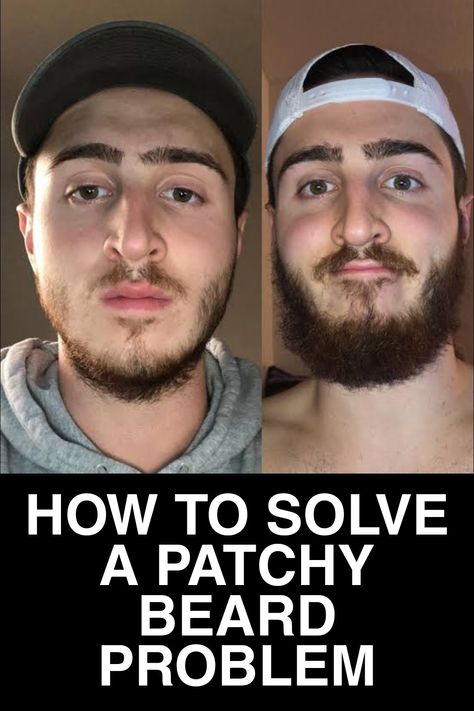 Beard Bald, Patchy Beard Styles, Beard Growth Tips, Beard Styles Bald, Natural Beard Growth, Growing Facial Hair, Facial Hair Growth, Patchy Beard, Hair Growth For Men