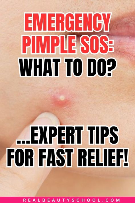 woman with a big pimple How To Deal With Pimples, What To Put On Pimples Overnight, Deep Pimple Remedies Overnight, How To Bring A Pimple To A Head Fast, Getting Rid Of Pimples Fast, Pimple Redness Reducer, Best Way To Get Rid Of Pimples Overnight, How To Remove A Pimple Instantly, Quickest Way To Get Rid Of Pimples