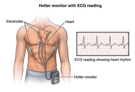 Holter Monitor | Johns Hopkins Medicine Holter Monitor, Parts Of The Heart, Heart Palpitations, Heart Care, Atrial Fibrillation, Low Blood Pressure, Heart Conditions, Shortness Of Breath, Johns Hopkins