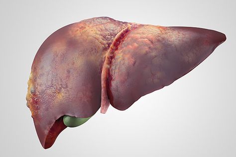 Anemia is a major risk factor for patients with both compensated and decompensated cirrhosis, increasing the odds of hepatic decompensation and/or mortality. Angelica Sinensis, Human Liver, Iron Deficiency, Body Organs, Types Of Cancers, Liver Health, Chronic Inflammation, Medical Prescription, 3d Illustration