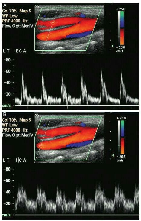 Carotid Artery Ultrasound, Carotid Ultrasound, External Carotid Artery, Diagnostic Medical Sonography Student, Ultrasound School, Ultrasound Physics, Arteries Anatomy, Cardiac Sonography, Vascular Ultrasound