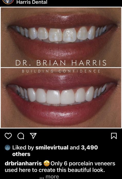 Veneers Teeth Styles, Teeth Goals, Teeth Veneers, Pretty Teeth, Tooth Care, Veneers Teeth, Windows To The Soul, Surgical Procedures, Beautiful Teeth