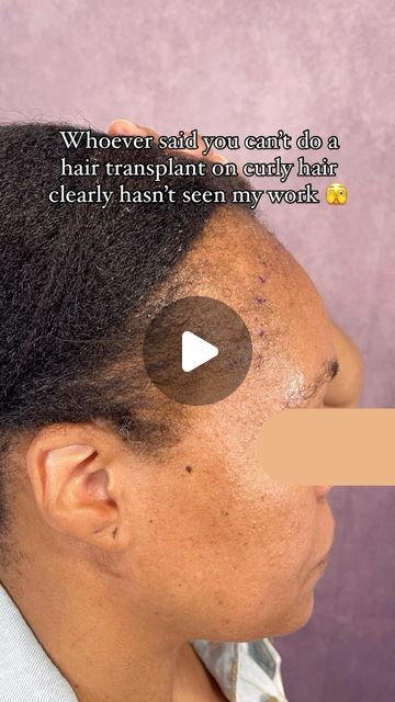 Crown Hair Institute on Instagram: "Her edges are BACK back 👏🏾 #hairtransplantresults We are 1 year post-hair transplant and she couldn’t be happier with her results. 

Traction Alopecia is no match for the hair experts at Crown Hair Institute! Book your FREE consultation with me today!

📲 (323) 947 2126
📍 150 S Rodeo Drive, Beverly Hills

#hairlinerestoration #hairlosssolution #hairlosstreatment #tractionalopecia #hairgrowthjourney" Traction Alopecia Hairstyles, Rodeo Drive Beverly Hills, Alopecia Hairstyles, Traction Alopecia, Hair Transplant Results, Back Back, Crown Hair, Rodeo Drive, Hair Transplant