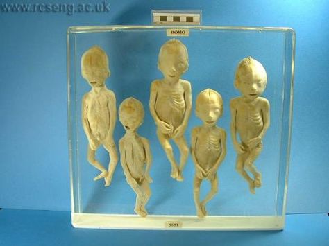 RCSHC/3681  Quintuple foetuses, from a premature birth at about five months. 1786 Premature Birth, Royal Society, Subjects, History, Quick Saves