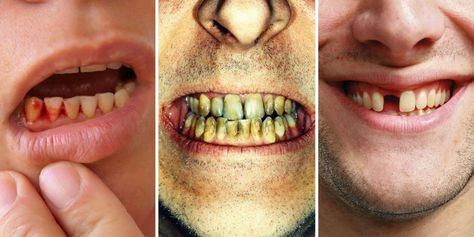 Teeth Problems, Oral Health Education, Health Post, Nice Teeth, Teeth Health, Receding Gums, Dental Problems, Wisdom Teeth, Teeth Care