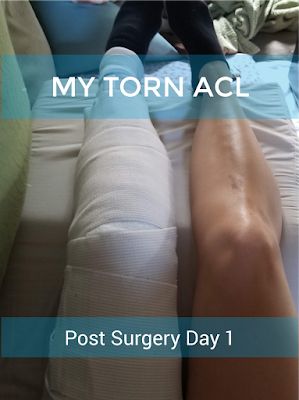 Acl Recovery Gifts, Acl And Meniscus Surgery Recovery, Acl Surgery Care Package, Acl Surgery Recovery Tips, Post Acl Surgery, Acl Surgery Recovery, Meniscus Surgery, Acl Knee, Acl Reconstruction Surgery