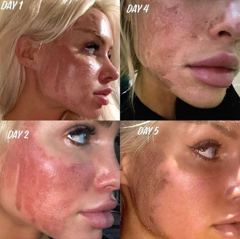 Chemical Peel Before And After, Chemical Peel Results, Best Chemical Peel, Skin Tightening Treatments, Chemical Peels, Pass Out, Cell Phone Number, Straight Forward, Be Pretty