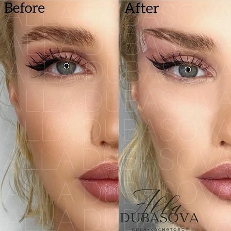 Eye Lift Surgery, Rhinoplasty Nose Jobs, Eye Trends, Eyebrow Lift, Cheek Fillers, Jenner Makeup, Thread Lift, Fox Eyes, Facial Aesthetics