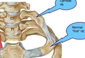 Cervical ribs are usually small and of no clinical significance but occasionally they cause a Thoracic Outlet Syndrome. Cervical Rib, Rib Anatomy, Thoracic Outlet, Rib Pain, Sore Shoulder, Ulnar Nerve, First Rib, Chronic Lower Back Pain, Middle Back Pain