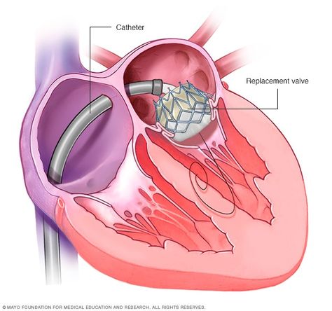 Mitral valve repair and mitral valve replacement - Care at Mayo Clinic - Mayo Clinic Mitral Valve Regurgitation, Prothrombin Time, Cardiac Sonography, Heart Valve, Nurse Teaching, Tricuspid Valve, Mitral Valve, Lung Transplant, Vascular Surgery