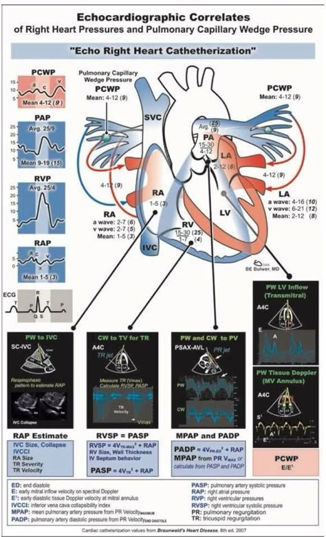 Echo. Right heart catheterization Right Heart Catheterization, Echo Cardiography, Cath Lab Nursing, Cardiac Cath Lab, Cardiovascular Sonography, Cardiac Ultrasound, Cardiovascular Nursing, Cardiac Cath, Heart Catheterization