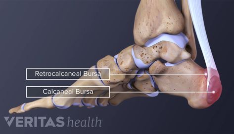 Heel (Retrocalcaneal and Calcaneal) Bursitis | Arthritis-health Heel Bursitis, Achilles Tendinopathy, Synovial Fluid, Primary Care Physician, Medical Terms, Family Medicine, Feeling Hot, Calf Muscles, Heel Pain