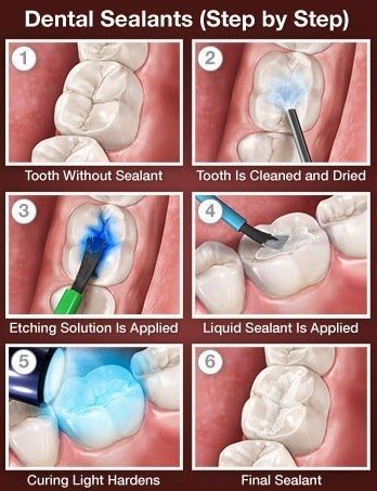 Dental sealants are a clear and protective coating that is applied to the biting surfaces of the back teeth. The sealant protects the tooth from getting a cavity by shielding against bacteria and plaque. Sealants are most commonly placed on children's permanent back teeth because they are more prone to cavities.  Dentaltown - Patient Education Ideas Hygiene School, Dental Assistant Study, Dental Sealants, Dental Hygiene Student, Dental Spa, Dental World, Kedokteran Gigi, Dental Hygiene School, Dental Anatomy