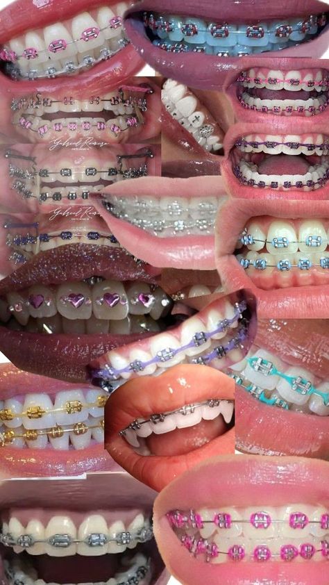 Braces Colors Combinations, Cute Braces Colors, Hello Kitty Nails Art, Pretty Teeth, Braces Tips, Getting Braces, Cute Braces, Brace Face, Braces Colors