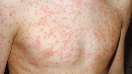 Rashes and spots in children with pictures | MadeForMums.com Page 9 Viral Rash, Skin Breaking Out, Calamine Lotion, Antifungal Cream, Itchy Rash, Cerebrospinal Fluid, Sweat Gland, Viral Infection, Study Photos