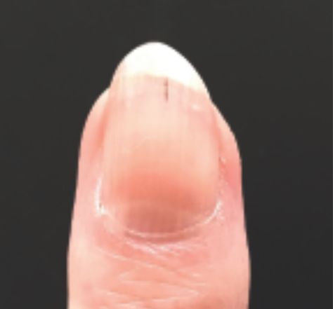 Damage to the capillaries under the nail; gives the appearance of a lengthwise small splinter underneath the nail plate. Caused by physical trauma or injury to the nail bed. Nail Disorders, Nail Bed, Nail Plate, Disease, Nails, Bed