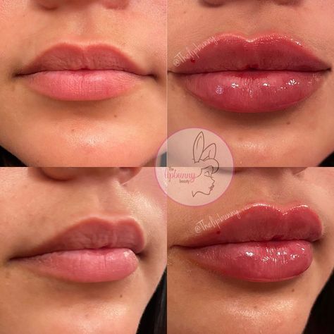 🐰 THE LIP BUNNY ™️ RN, BSN on Instagram: “First time lip fill with @thelipbunny 💉💉 1ML result with #juvederm 👄👄 SWIPE for live results • • #lips #lipinjections #lipgloss #lipfiller…” 1ml Lip Filler Small Lips, Lip Fillers Heart Shape, Jolie Lip Filler, Lip Fillers On Black Women, Russian Style Lip Fillers, Defined Cupids Bow Lip Filler, Slight Lip Filler, Beautiful Lips Aesthetic, Lip Filler On Full Lips